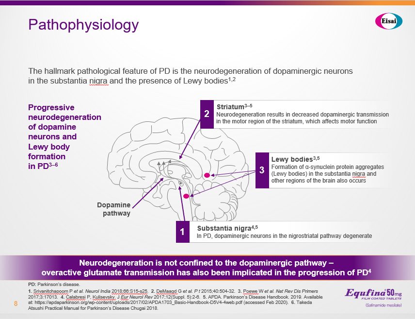 Pathophysiology slide from a Parkinson's disease presentation